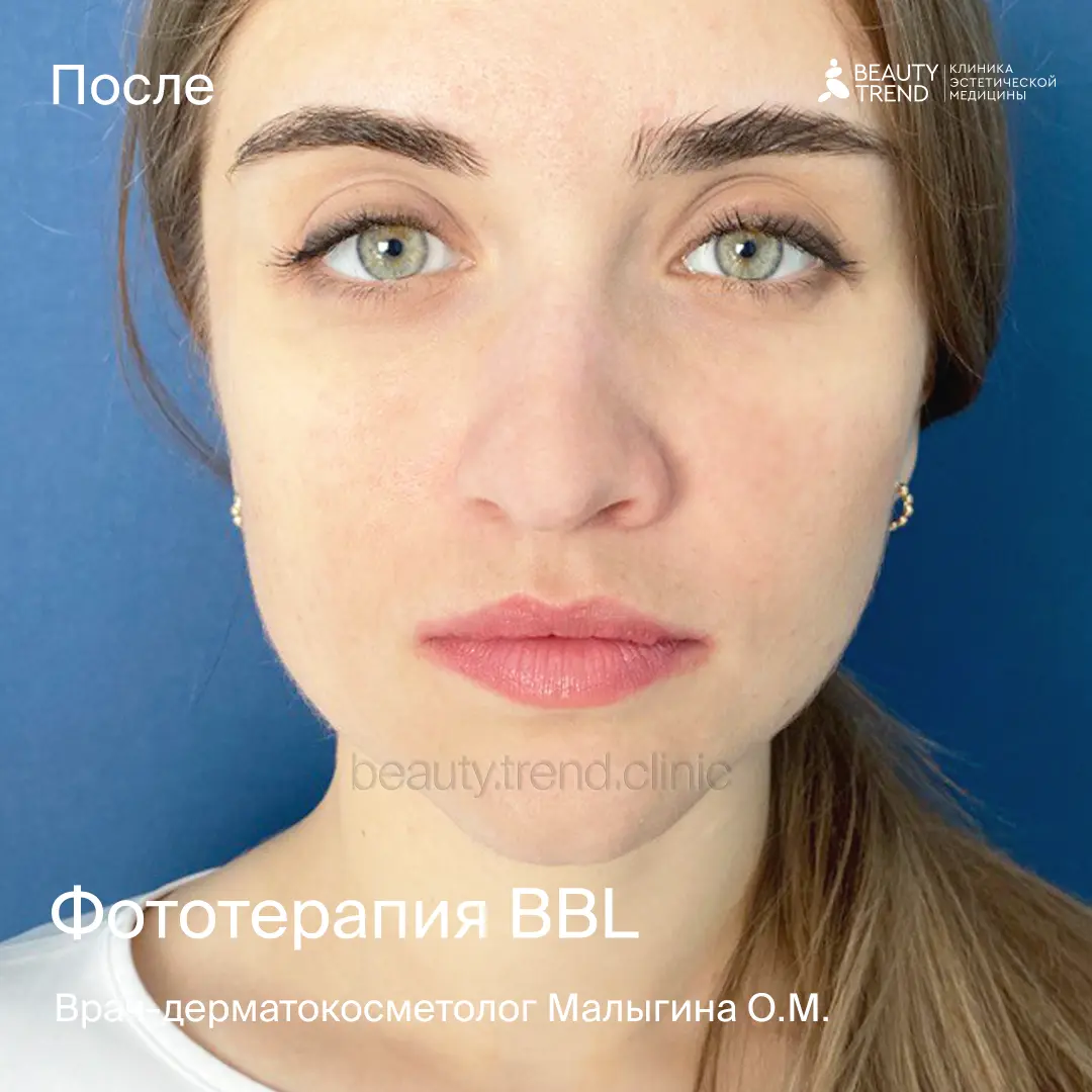 Фототерапия BBL, Малыгина - после 1